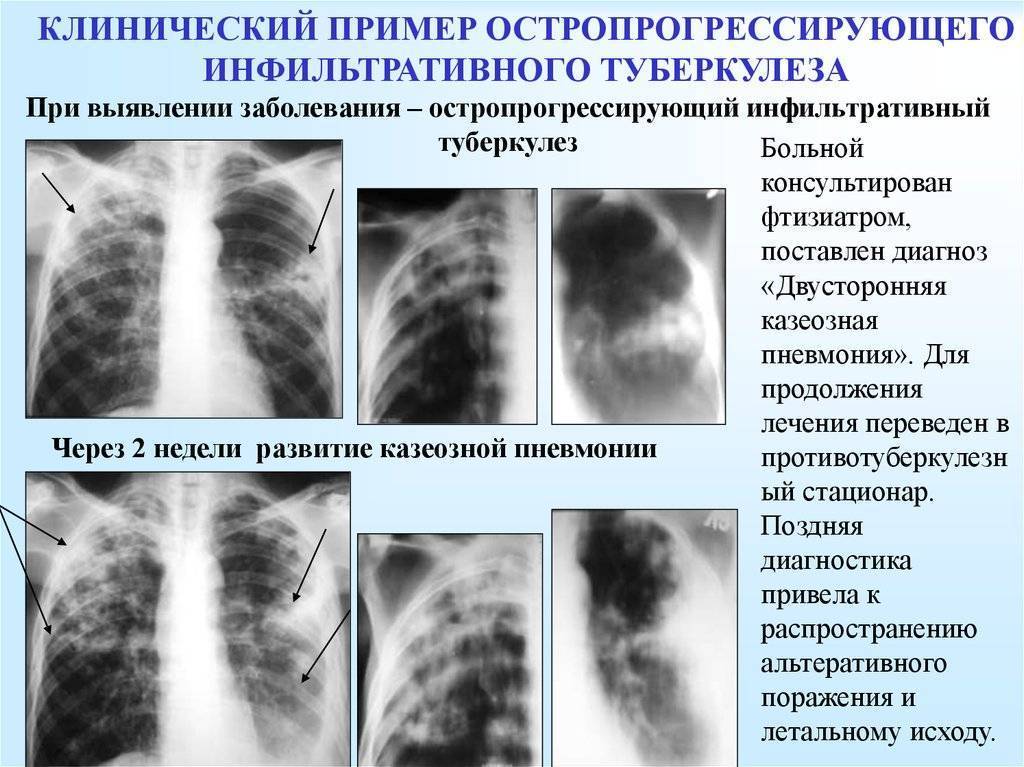 Распад туберкулезного инфильтрата сформировавшегося в стенке бронха приводит к появлению