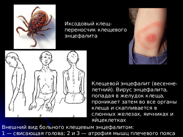 Иксодовый клещ- переносчик клещевого энцефалита Клещевой энцефалит (весенне-летний). Вирус энцефалита, попадая в желудок клеща, проникает затем во все органы клеща и скапливается в слюнных железах, яичниках и яйцеклетках Внешний вид больного клещевым энцефалитом: 1 — свисающая голова; 2 и 3 — атрофия мышц плечевого пояса 