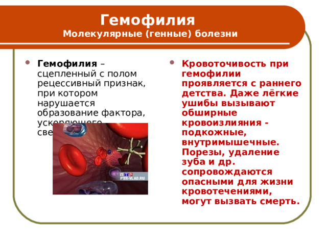 Гемофилия  Молекулярные (генные) болезни Гемофилия – сцепленный с полом рецессивный признак, при котором нарушается образование фактора, ускоряющего свертывание крови  Кровоточивость при гемофилии проявляется с раннего детства. Даже лёгкие ушибы вызывают обширные кровоизлияния - подкожные, внутримышечные. Порезы, удаление зуба и др. сопровождаются опасными для жизни кровотечениями, могут вызвать смерть.   