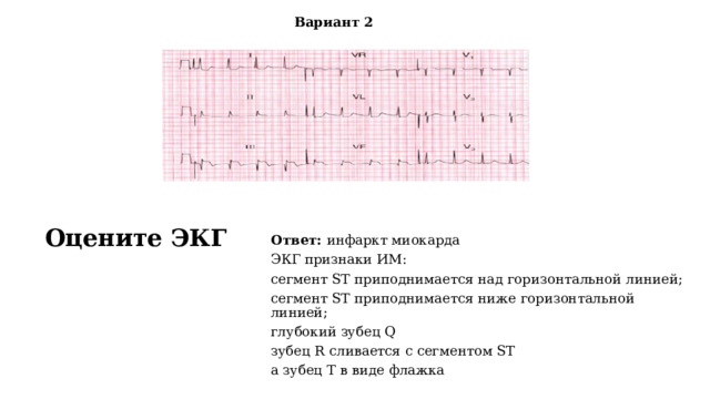 Вариант 2 Оцените ЭКГ Ответ: инфаркт миокарда  ЭКГ признаки ИМ: сегмент ST приподнимается над горизонтальной линией; сегмент ST приподнимается ниже горизонтальной линией; глубокий зубец Q зубец R сливается с сегментом ST а зубец T в виде флажка 