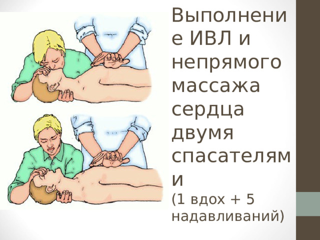 Выполнение ИВЛ и непрямого массажа сердца  двумя спасателями  (1 вдох + 5 надавливаний) 