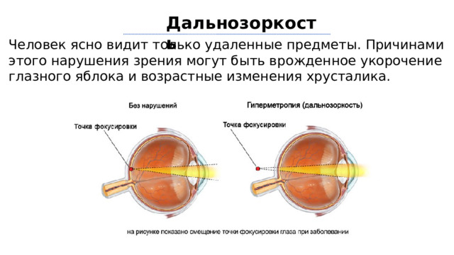 Дальнозоркость Человек ясно видит только удаленные предметы. Причинами этого нарушения зрения могут быть врожденное укорочение глазного яблока и возрастные изменения хрусталика. 