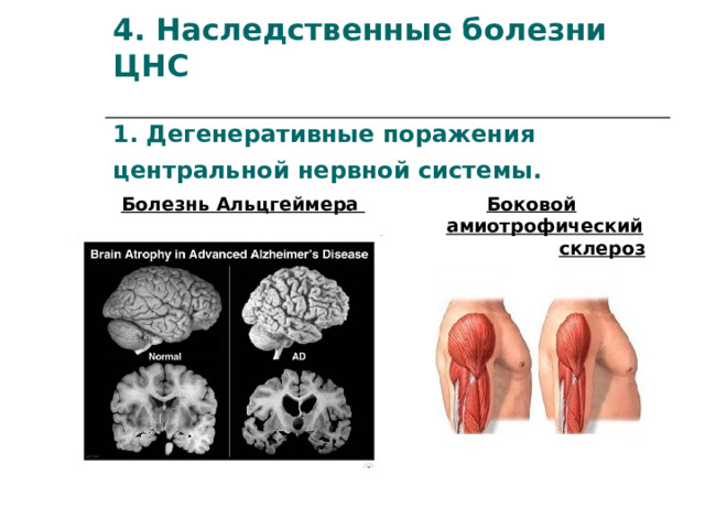 4. Наследственные болезни ЦНС    1. Дегенеративные поражения центральной нервной системы.   Болезнь Альцгеймера   Боковой амиотрофический   склероз  