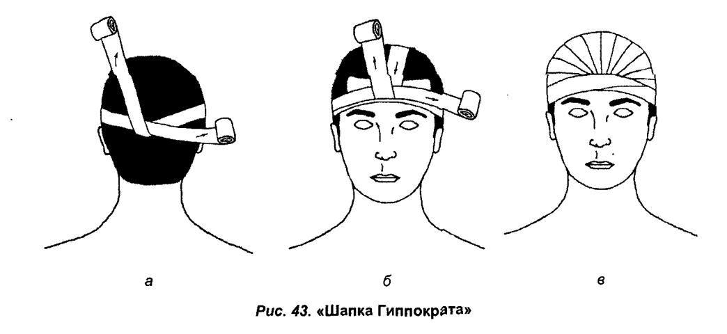 Техника наложения шапочки гиппократа. Схема наложения повязки шапка Гиппократа. Перевязка шапочка Гиппократа. Шапка Гиппократа повязка. Бинтование головы шапочка Гиппократа.
