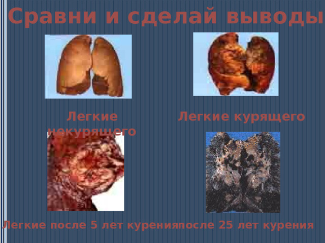 Сравни и сделай выводы Легкие некурящего Легкие курящего Легкие после 5 лет курения  после 25 лет курения 