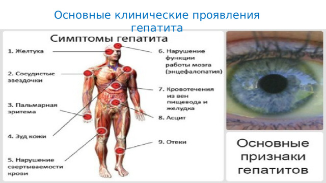 Основные клинические проявления гепатита 