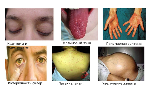 Малиновый язык Ксантомы и ксантелазмы Пальмарная эритема Иктеричность склер Петехиальная сыпь Увеличение живота 