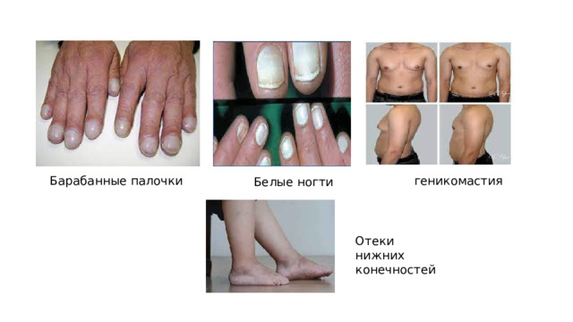 Барабанные палочки геникомастия Белые ногти Отеки нижних конечностей 
