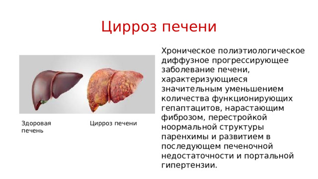 Цирроз печени Хроническое полиэтиологическое диффузное прогрессирующее заболевание печени, характеризующиеся значительным уменьшением количества функционирующих гепаптацитов, нарастающим фиброзом, перестройкой ноормальной структуры паренхимы и развитием в последующем печеночной недостаточности и портальной гипертензии. Здоровая печень Цирроз печени 