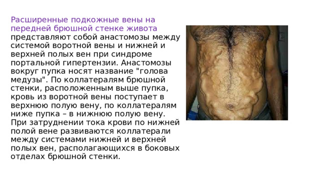Расширенные подкожные вены на передней брюшной стенке живота представляют собой анастомозы между системой воротной вены и нижней и верхней полых вен при синдроме портальной гипертензии. Анастомозы вокруг пупка носят название 