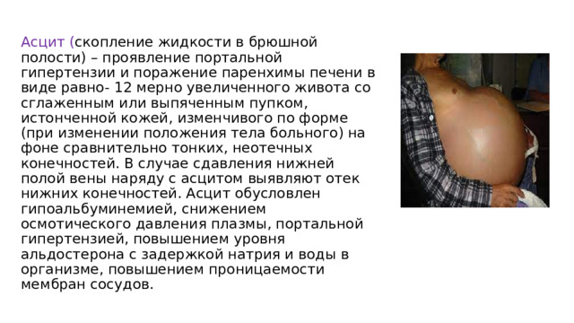 Асцит ( скопление жидкости в брюшной полости) – проявление портальной гипертензии и поражение паренхимы печени в виде равно- 12 мерно увеличенного живота со сглаженным или выпяченным пупком, истонченной кожей, изменчивого по форме (при изменении положения тела больного) на фоне сравнительно тонких, неотечных конечностей. В случае сдавления нижней полой вены наряду с асцитом выявляют отек нижних конечностей. Асцит обусловлен гипоальбуминемией, снижением осмотического давления плазмы, портальной гипертензией, повышением уровня альдостерона с задержкой натрия и воды в организме, повышением проницаемости мембран сосудов. 