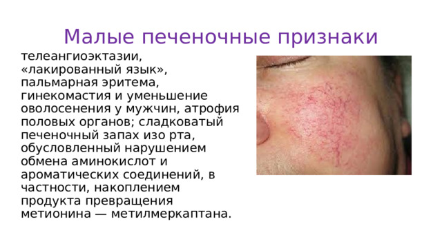 Малые печеночные признаки телеангиоэктазии, «лакированный язык», пальмарная эритема, гинекомастия и уменьшение оволосенения у мужчин, атрофия половых органов; сладковатый печеночный запах изо рта, обусловленный нарушением обмена аминокислот и ароматических соединений, в частности, накоплением продукта превращения метионина — метилмеркаптана. 