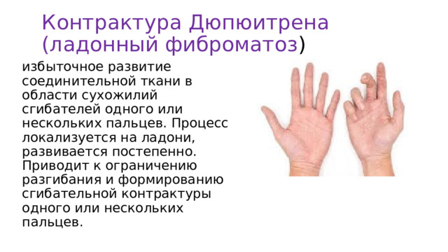 Контрактура Дюпюитрена (ладонный фиброматоз ) избыточное развитие соединительной ткани в области сухожилий сгибателей одного или нескольких пальцев. Процесс локализуется на ладони, развивается постепенно. Приводит к ограничению разгибания и формированию сгибательной контрактуры одного или нескольких пальцев. 
