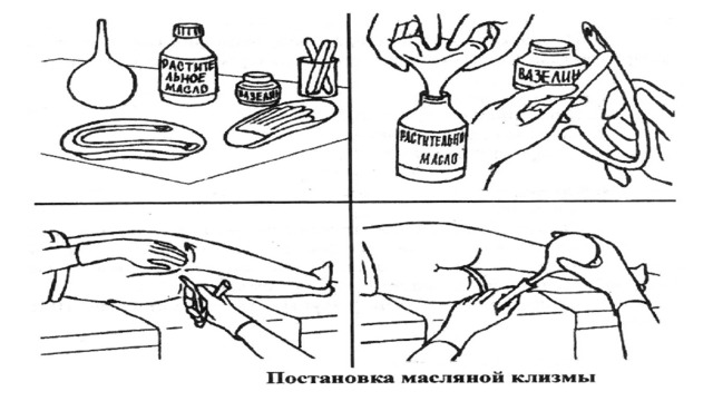 При постановке масляной клизмы газоотводную трубку вводят