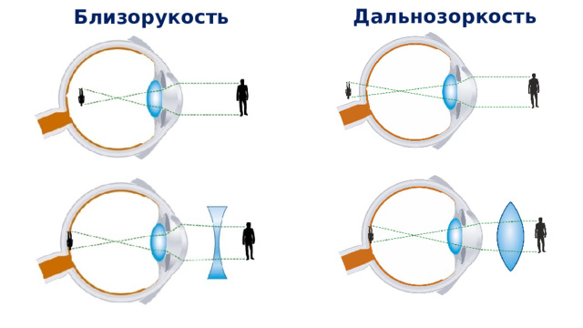 Дальнозоркость Близорукость 