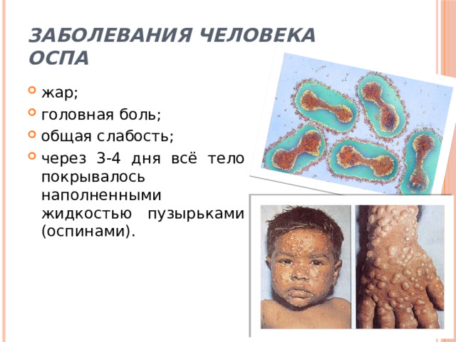 Заболевания человека  Оспа жар; головная боль; общая слабость; через 3-4 дня всё тело покрывалось наполненными жидкостью пузырьками (оспинами). 