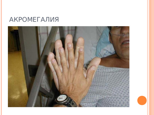 АКРОМЕГАЛИЯ 