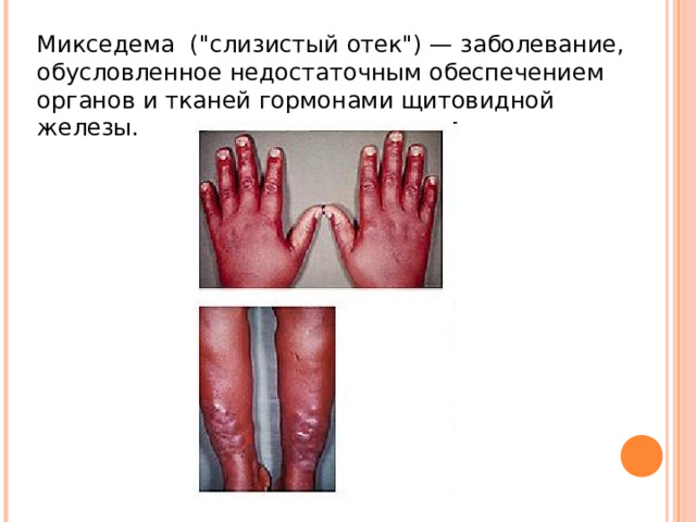 Микседема (