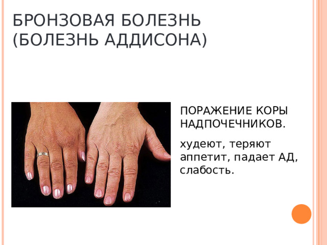 БРОНЗОВАЯ БОЛЕЗНЬ  (БОЛЕЗНЬ АДДИСОНА) ПОРАЖЕНИЕ КОРЫ НАДПОЧЕЧНИКОВ. худеют, теряют аппетит, падает АД, слабость. 