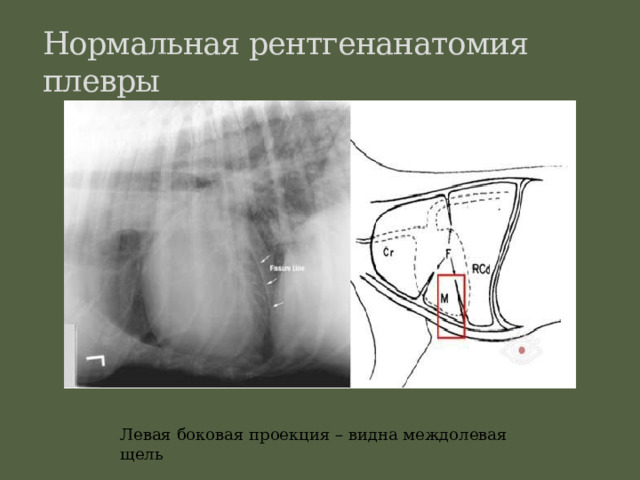 Нормальная рентгенанатомия плевры Левая боковая проекция – видна междолевая щель  