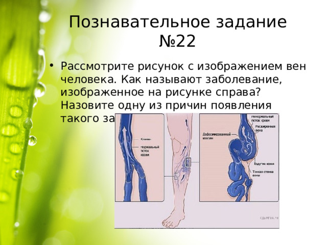 Познавательное задание №22 Рассмотрите рисунок с изображением вен человека. Как называют заболевание, изображенное на рисунке справа? Назовите одну из причин появления такого заболевания у человека. 