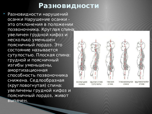 Разновидности Разновидности нарушений осанки Нарушение осанки - это отклонения в положении позвоночника. Круглая спина: увеличен грудной кифоз и несколько уменьшен поясничный лордоз. Это состояние называется сутулостью. Плоская спина: грудной и поясничный изгибы уменьшены, амортизационная способность позвоночника снижена. Седлообразная (кругловогнутая) спина: увеличены грудной кифоз и поясничный лордоз, живот выпячен. 