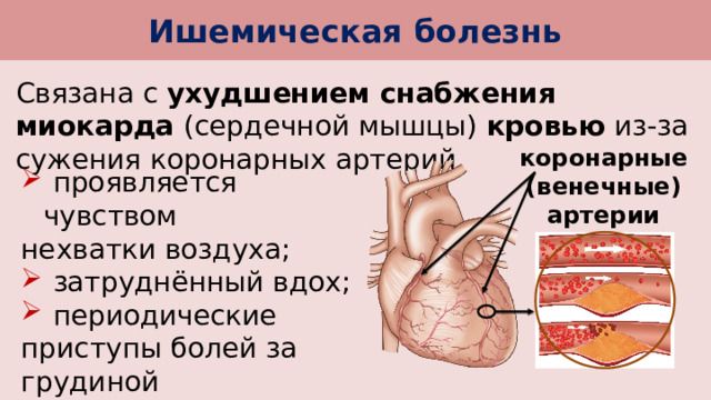 Ишемическая болезнь Связана с ухудшением снабжения миокарда (сердечной мышцы) кровью из-за сужения коронарных артерий. коронарные (венечные) артерии  проявляется чувством нехватки воздуха;  затруднённый вдох;  периодические приступы болей за грудиной (стенокардия). 