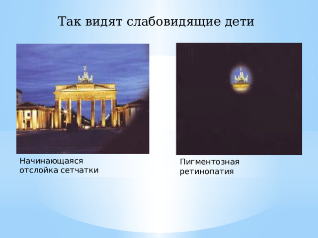 Так видят слабовидящие дети Начинающаяся отслойка сетчатки Пигментозная ретинопатия 