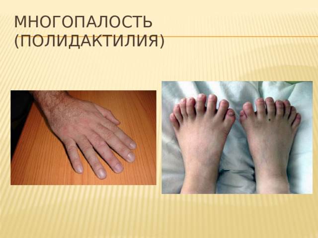 Многопалость (полидактилия) 