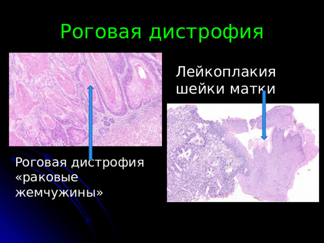Роговая дистрофия Лейкоплакия шейки матки Роговая дистрофия «раковые жемчужины» 