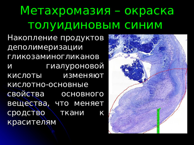 Метахромазия – окраска толуидиновым синим Накопление продуктов деполимеризации гликозаминогликанов и гиалуроновой кислоты изменяют кислотно-основные свойства основного вещества, что меняет сродство ткани к красителям 