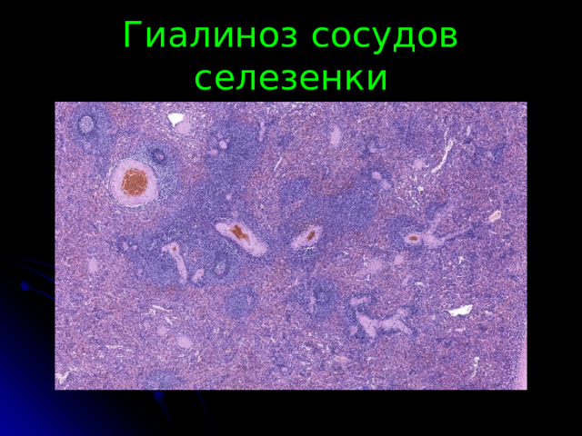 Гиалиноз сосудов селезенки 