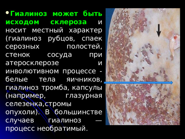 Гиалиноз может быть исходом склероза и носит местный характер (гиалиноз рубцов, спаек серозных полостей, стенок сосуда при атеросклерозе и инволютивном процессе - белые тела яичников, гиалиноз тромба, капсулы (например, глазурная селезенка,стромы опухоли). В большинстве случаев гиалиноз — процесс необратимый. 