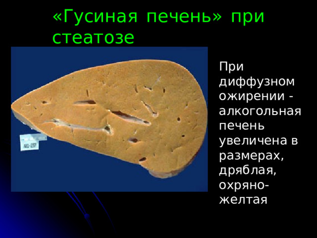 «Гусиная печень» при стеатозе При диффузном ожирении - алкогольная печень увеличена в размерах, дряблая, охряно-желтая 