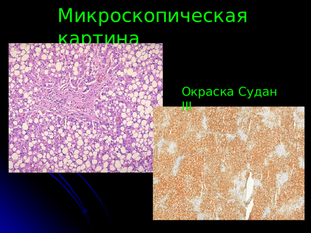 Микроскопическая картина Окраска Судан III 