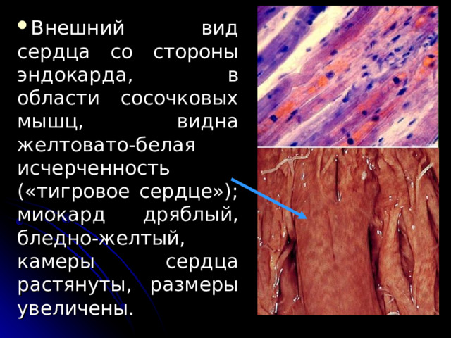 Внешний вид сердца  со стороны эндокарда, в области сосочковых мышц, видна желтовато-белая исчерченность («тигровое сердце»); миокард дряблый, бледно-желтый, камеры сердца растянуты, размеры увеличены. 