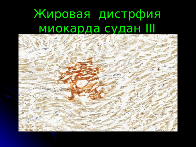 Жировая дистрфия миокарда судан III 