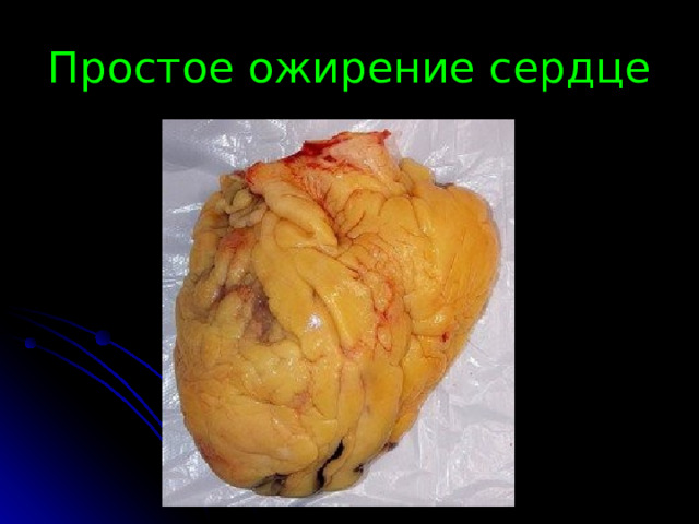 Простое ожирение сердце 