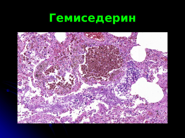 Гемиседерин 