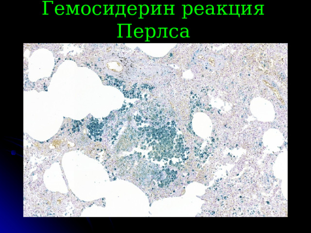 Гемосидерин реакция Перлса 