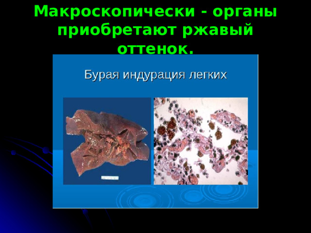 Макроскопически - органы приобретают ржавый оттенок. 