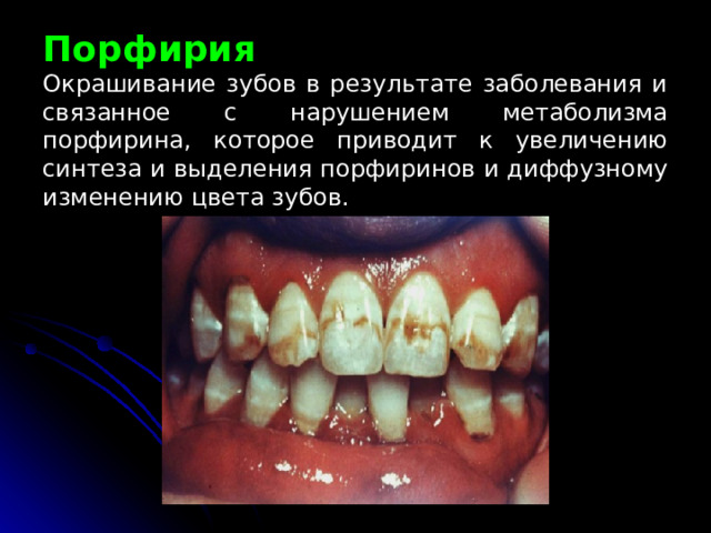 Порфирия  Окрашивание зубов в результате заболевания и связанное с нарушением метаболизма порфирина,  которое приводит к увеличению синтеза и выделения порфиринов и диффузному изменению цвета зубов. 