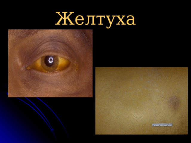 Желтуха 
