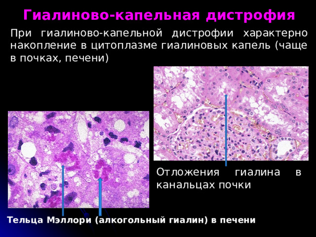 Гиалиново-капельная дистрофия При гиалиново-капельной дистрофии характерно накопление в цито­плазме гиалиновых капель (чаще в почках, печени) Отложения гиалина в канальцах почки Тельца Мэллори (алкогольный гиалин) в печени 