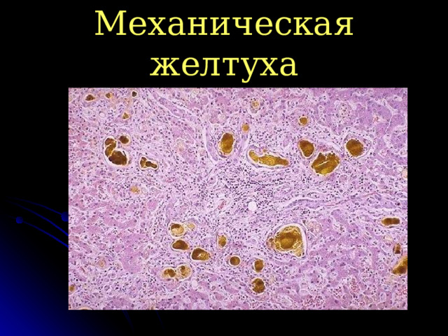 Механическая желтуха 