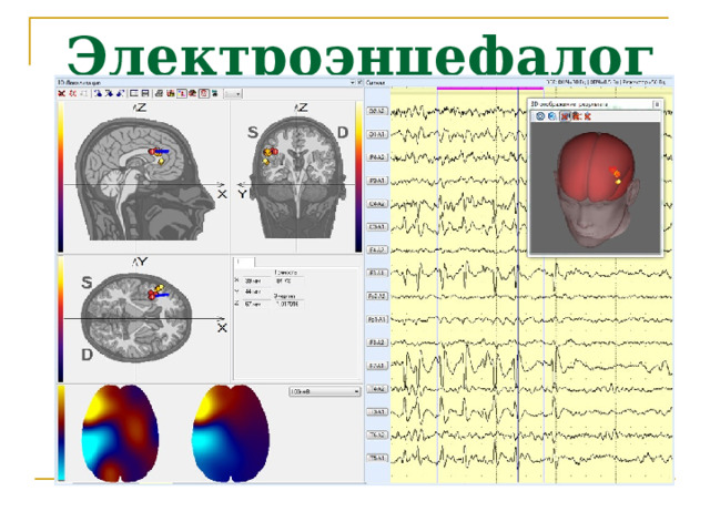 Электроэнцефалограф 