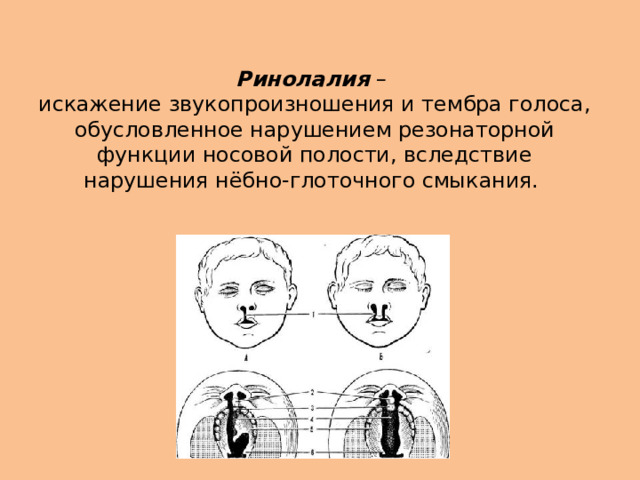 Ринолалия –  искажение звукопроизношения и тембра голоса, обусловленное нарушением резонаторной функции носовой полости, вследствие нарушения нёбно-глоточного смыкания. 