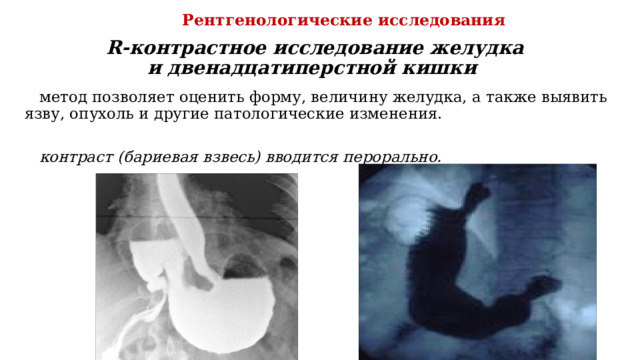 Рентгенологические исследования R-контрастное исследование желудка  и двенадцатиперстной кишки  метод позволяет оценить форму, величину желудка, а также выявить язву, опухоль и другие патологические изменения. контраст (бариевая взвесь) вводится перорально. 