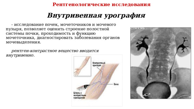 Рентгенологические исследования Внутривенная урография - исследование почек, мочеточников и мочевого пузыря, позволяет оценить строение полостной системы почки, проходимость и функцию мочеточника, диагностировать заболевания органов мочевыделения. рентген-контрастное вещество вводится внутривенно.  