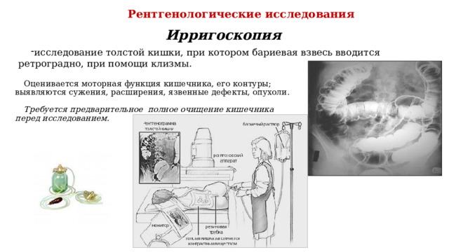 Рентгенологические исследования Ирригоскопия исследование толстой кишки, при котором бариевая взвесь вводится ретроградно, при помощи клизмы. Оценивается моторная функция кишечника, его контуры; выявляются сужения, расширения, язвенные дефекты, опухоли.  Требуется предварительное полное очищение кишечника перед исследованием. 